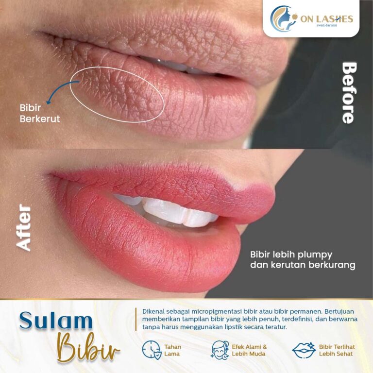 Sulam Bibir Bintaro